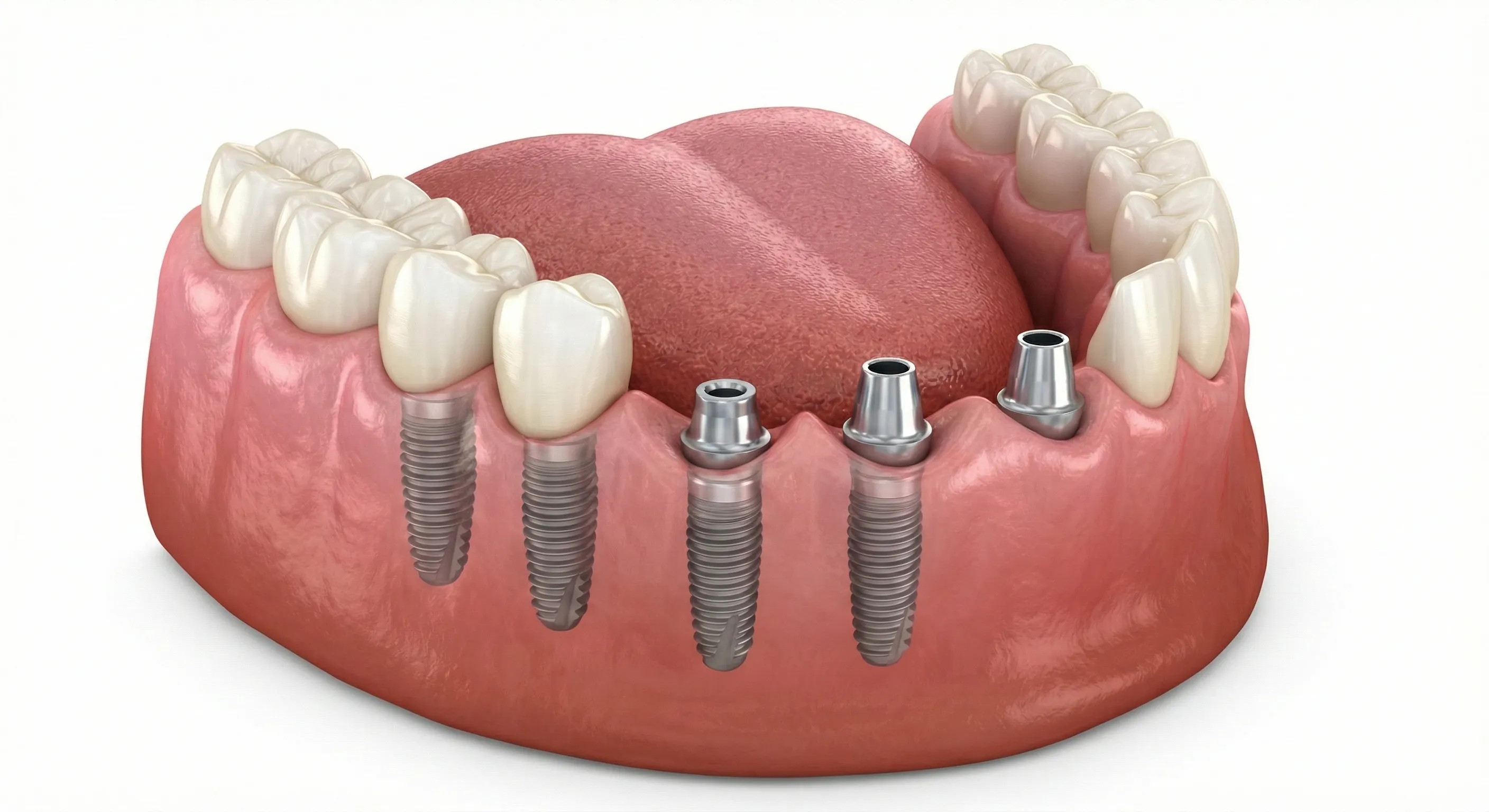 Dental Implants